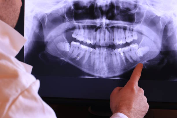 Best Knocked-Out Tooth (Avulsed Tooth) Treatment in Buchanan, NY